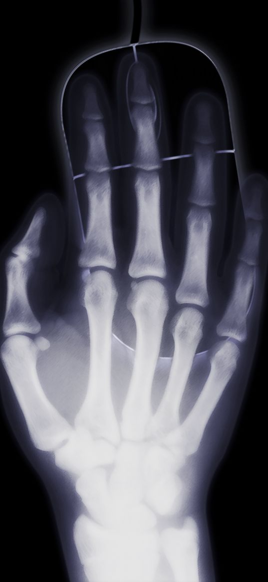 arm, x-ray, bone, computer mouse